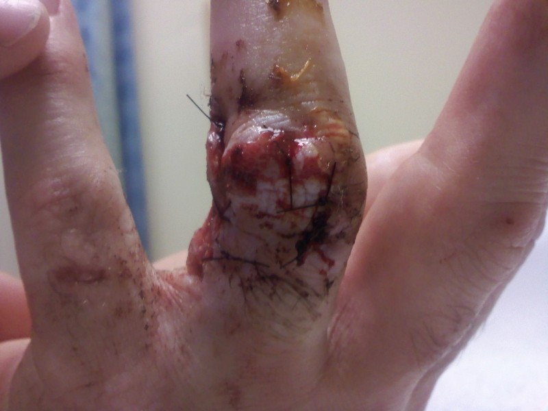 This was friday a week after i trier to cut it off. what an idiot!