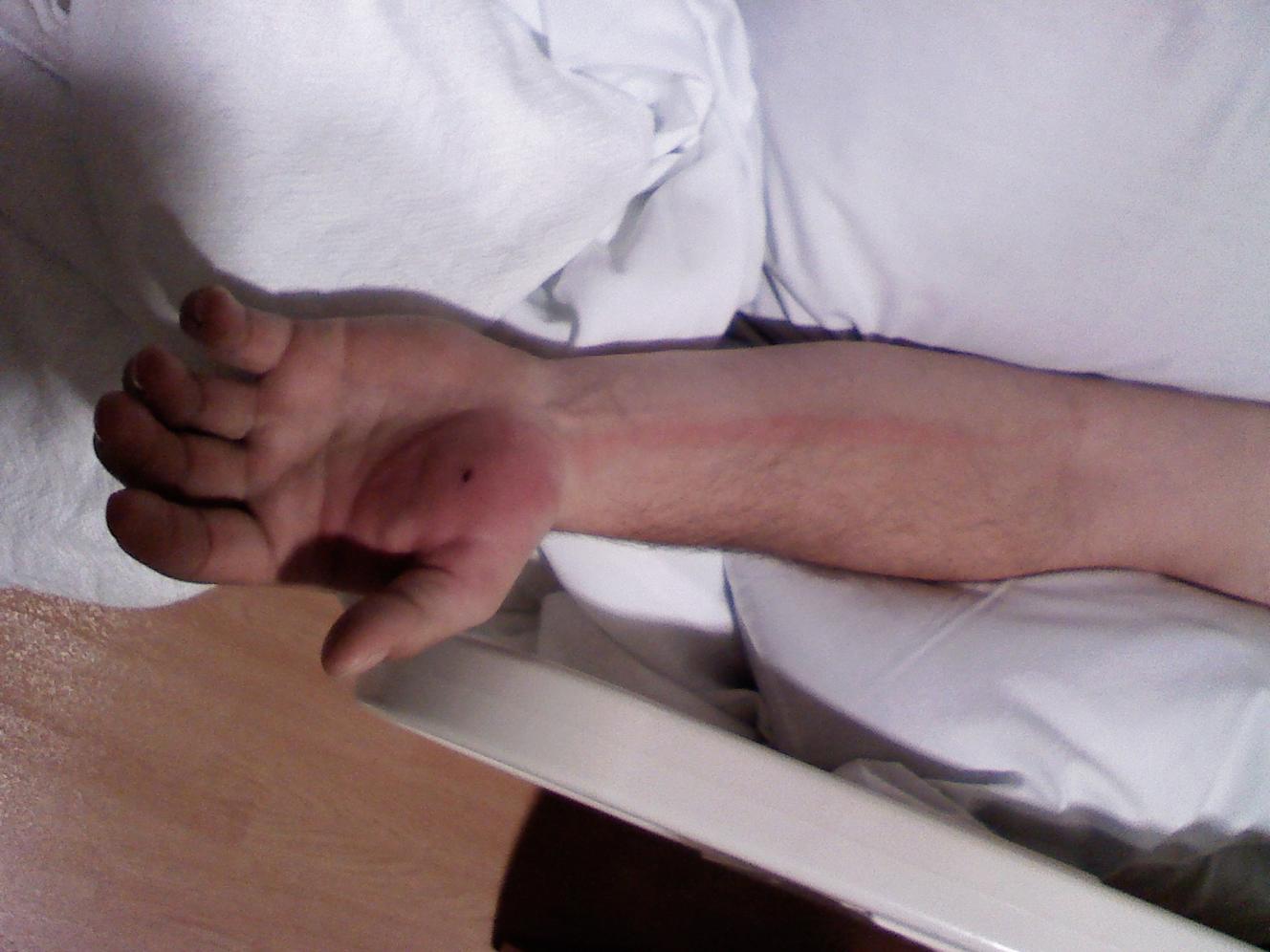 8 hrs after dog bite