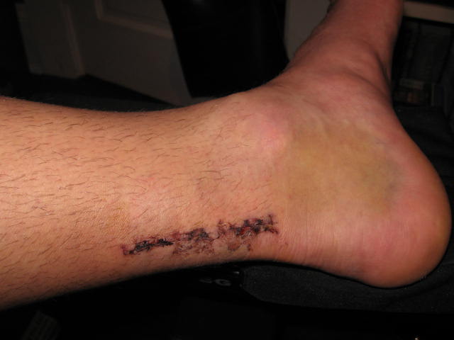 Soo stoked for the new season!! Got my stitches pulled out yesterday..